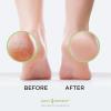 imageFoot Callus Remover Gel Set  Professional Callus Remover for Feet Calloused Feet Remover Gel  Pedicure Kit ampamp Foot Spa Tools  Feet Callus Remover  8oz w 16oz Tea Tree Oil Foot Soak  USACallus Gel  TTO Foot Soak